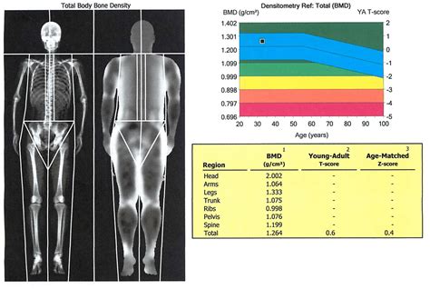 Dexa Scan Max Superspecialty Ortho Clinic