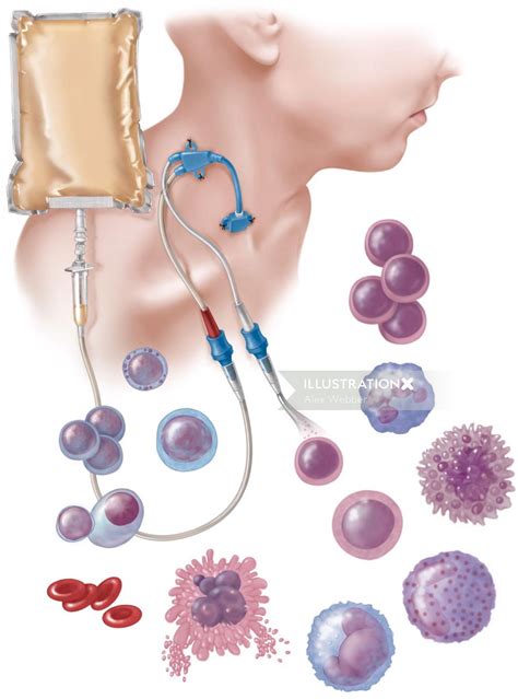 Hematopoietic Stem Cell Transplant Illustration By Alex Webber