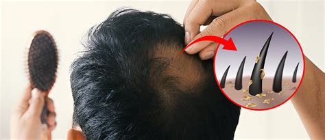 Top 5 Early Signs 8 Main Causes And 7 Best Treatments Of Balding