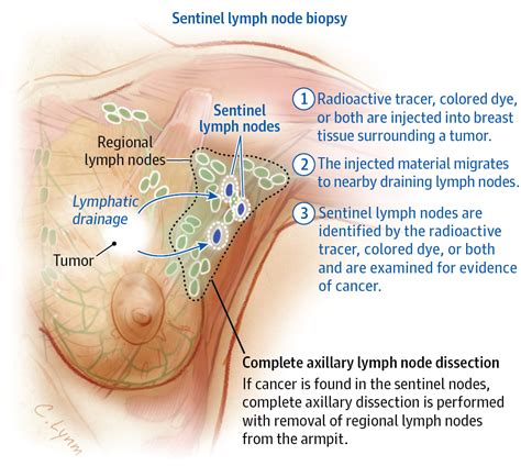 Lymph nodes are important sites of interaction between antigens, antigen presenting cells, and lymphocytes. Breast Cancer and Axillary Lymph Nodes. | Breast Cancer ...