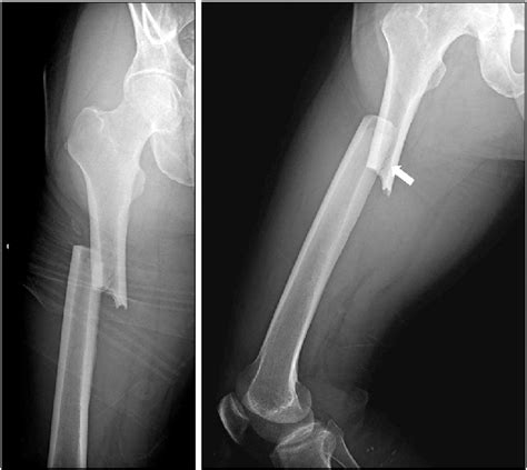 Right Femur Fracture