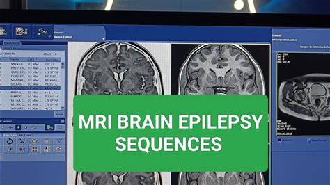 Mri Brain Epilepsy Protocol Sequences Seizure Protocol Identification