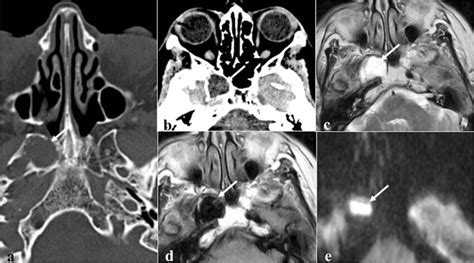 Sphenoid Epidermoid Cyst As An Incidental Finding In A 74 Year Old