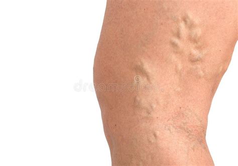 Varicose Veins On The Skin Macro Close Up Circulation Problem Medicine