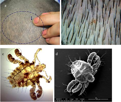 Observation Of Fungi Bacteria And Parasites In Clinical Skin Samples Using Scanning Electron
