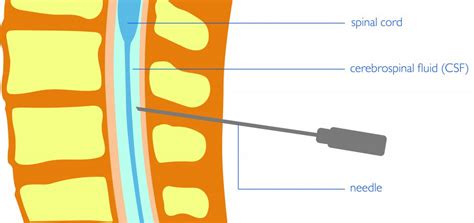 Brain And Spine Foundation Lumbar Puncture