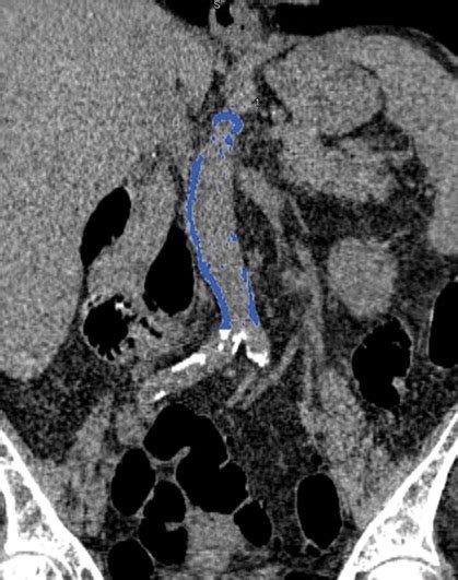 Multifocal Vascular Calcifications Causes Symptoms And Treatment