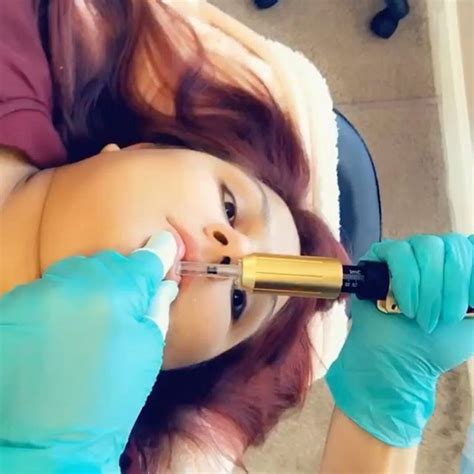 Nouvel acide hyaluronique injectable hyamira. Hyaluron pen Lèvres à Tournefeuille (31) Par Manon - Estheca