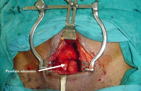 Figure From Suprapubic Prostatectomy With And Without Continuous Bladder Irrigation In A