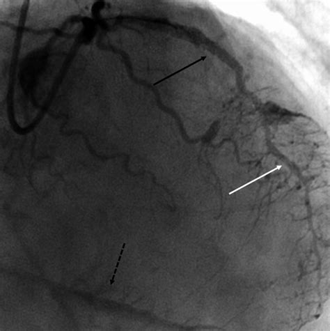 Completion Angiogram Taken From The Rao‐cranial Projection
