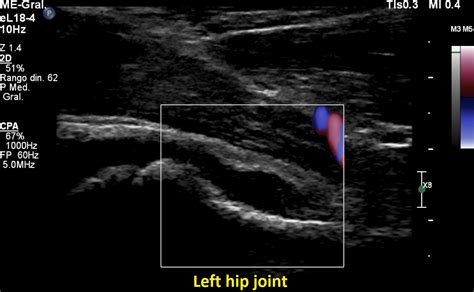 Hip Joint Septic Arthritis Ultrasound Image