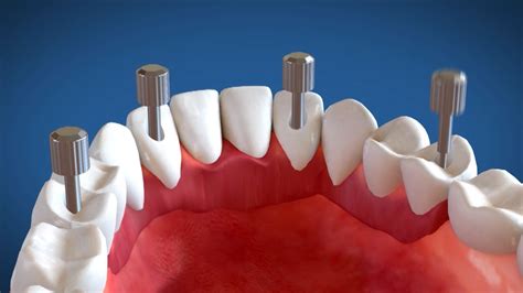 Video Animazione 3d Implantologia Dentale A Carico Immediato Sistema