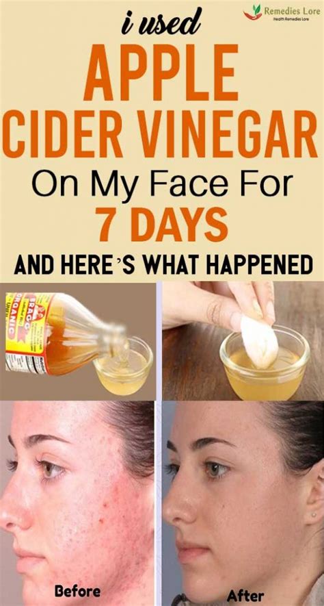 I Used Apple Cider Vinegar On My Face For 7 Days And Heres What