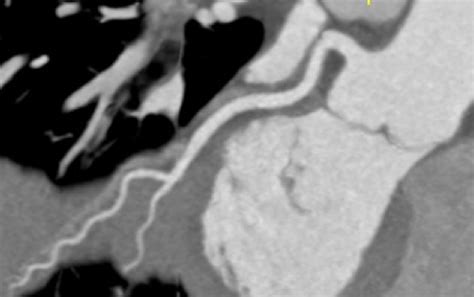 The Rise Of The Coronary Ct Angiogram