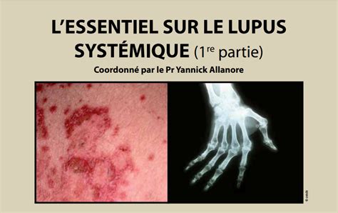 Doctidoc Lessentiel Sur Le Lupus Systémique 1re Partie