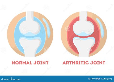 Normal And Arthritic Human Joint Anatomical Infographic Stock Vector