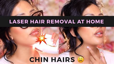 Laser Hair Removal AT HOME Thick Chin Hairs After 30 YouTube