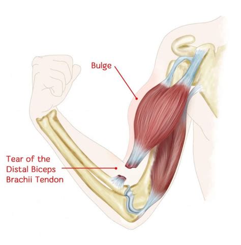 Distal Biceps Tendon Tear Dr Edward Weldon