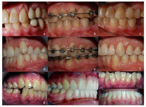 Applied Sciences Free Full Text The Impact Of Orthodontic Treatment