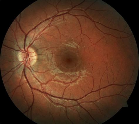 Retinal Detachment Retina Vitreous Of La