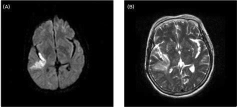 Diffusion Weighted Magnetic Resonance Imaging MRI A And T Weighted Download Scientific