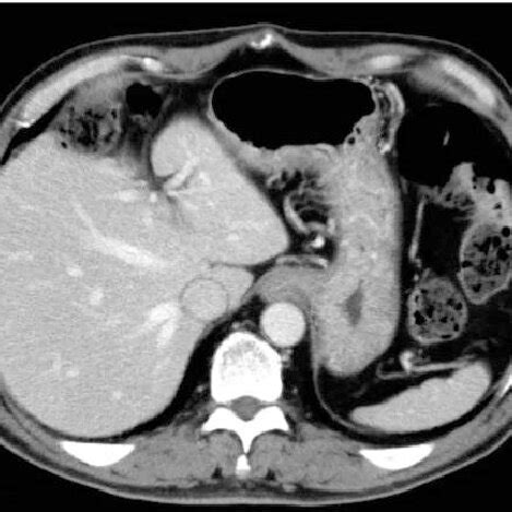 Contrast Enhanced Abdominal CT Findings No Abnormal Duodenal Findings
