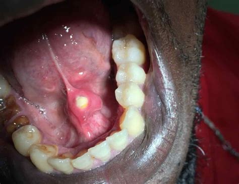 Image Of The Week A Hard Lesion Near The Frenulum Of The Tongue Clinical Advisor