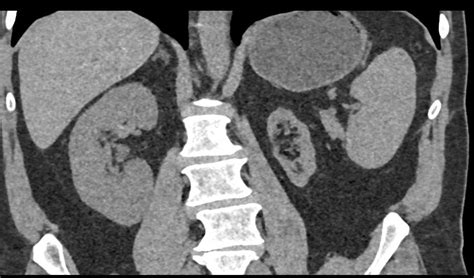 Left Renal Angiomyolipoma Kidney Case Studies Ctisus Ct Scanning