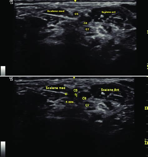 Ultrasound Guided Interscalene Brachial Plexus Block Intrafascial