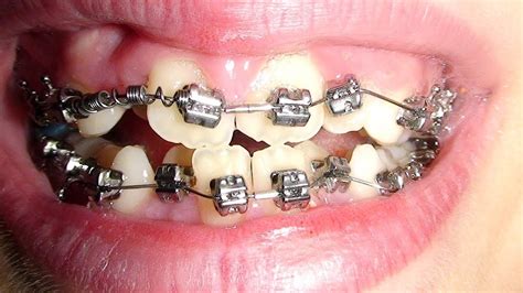 ortodoncia con brackets tratamiento completo con frenillos youtube