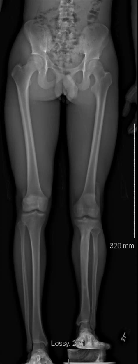 Orthokids Leg Length Discrepancy