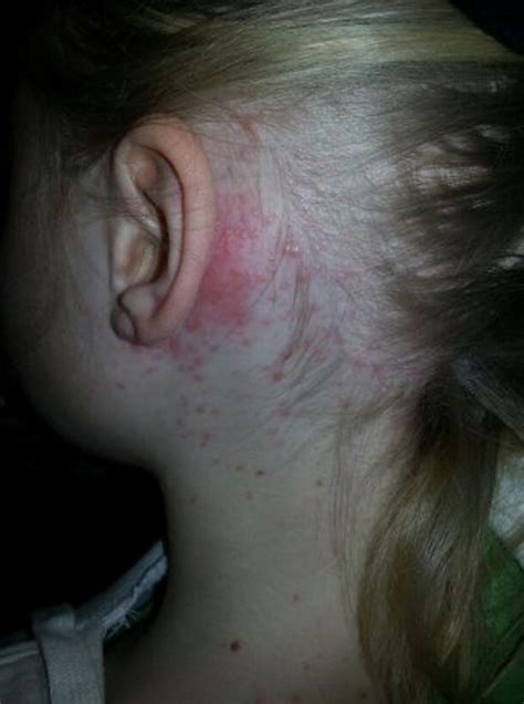 Rash On Neck And Behind Ears