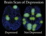 Images of Depression Brain