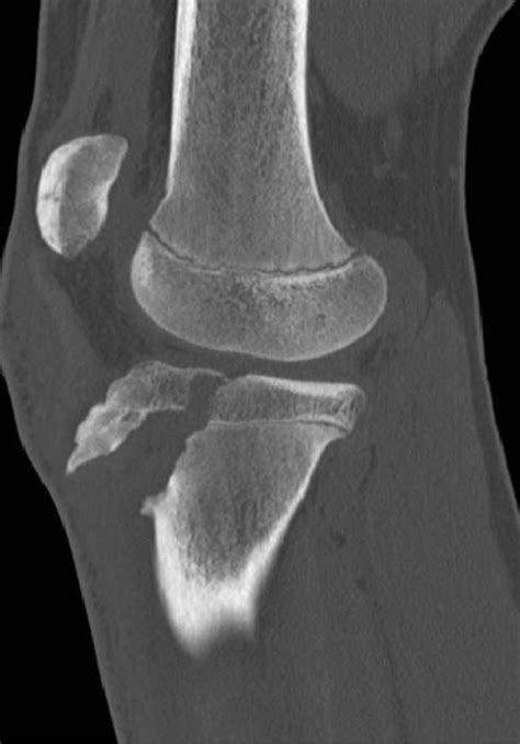 Imaging Review Of Adolescent Tibial Tuberosity Fractures Sexiz Pix