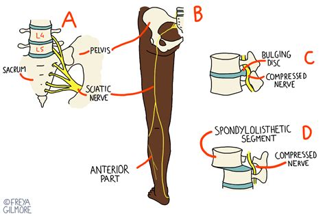 Sciatica And Piriformis Syndrome Beth Forrest Osteopathy