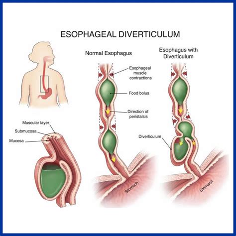 Symptoms Of Esophagus Diseases Gastro Esophageal Reflux Disease Gerd