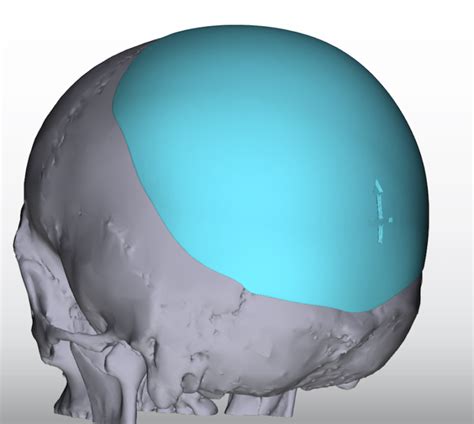 Custom Skull Implant Design For Flat Back Of The Head Left Oblique View