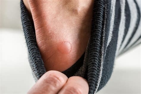 Blisters On The Feet Causes Treatment And Prevention