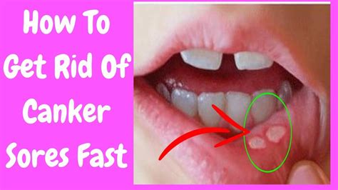 If there is bacterial infestation, it is possible that you haven't done any proper dental hygiene or. How to Get rid of Canker Sores Fast | Can You Get a Canker ...