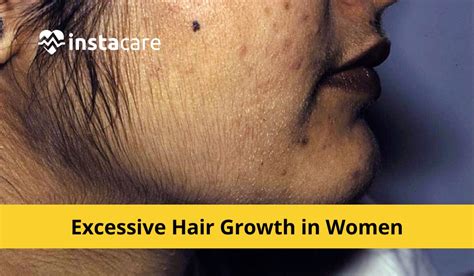 Share More Than 122 Excessive Hair Growth In Females Vn