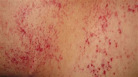 Petechiae Causes Treatments Pictures And More Leukemia Quotes