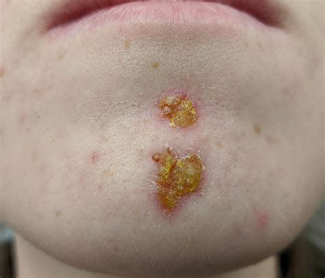 Resumo De Impetigo Diagnóstico Tratamento E Mais