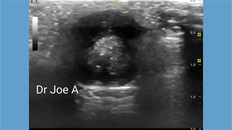 Trichilemmal Cyst Or Pilar Cyst Of Scalp Ultrasound And Color Doppler