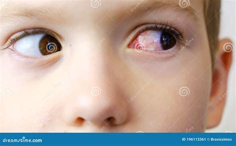 Eye Child Red Illness Conjunctivitis Face Stock Image Image Of