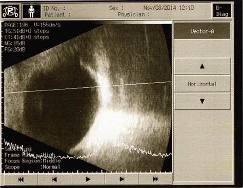 Ultrasound Of Both Eyes Showed A Scan With High Intensity Echo Spikes
