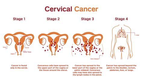 Cervical Cancer Patient Care