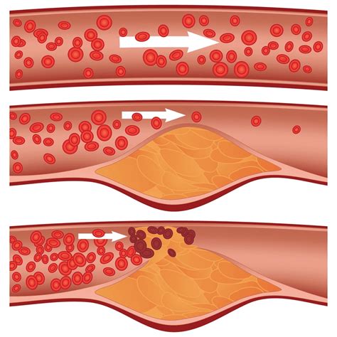 Warning Signs Of Clogged Arteries Commonwealth Vein Center Vascular
