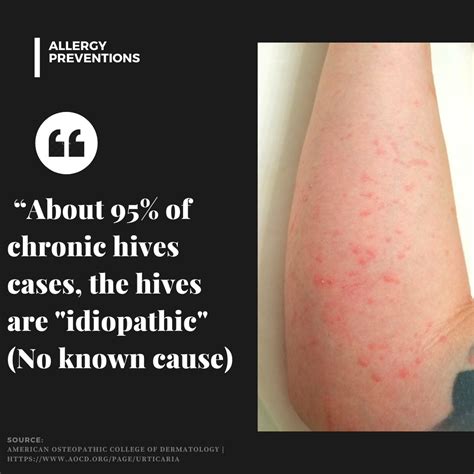 Hives Causes Idiopathic Allergy Preventions