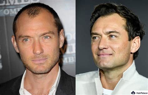 the jude law hair transplant mystery did he have one