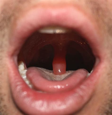 My Experience With Uvulitis Not Fun Patients Lounge